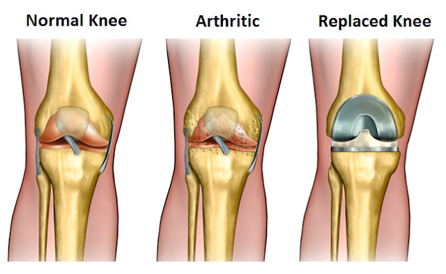 orthopedic implants Cuba