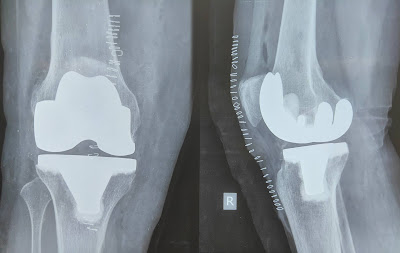 external fixation is one of the key topics in orthopedics