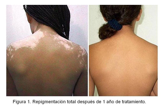 total repigmentation after 1 year application of Melagenina Plus